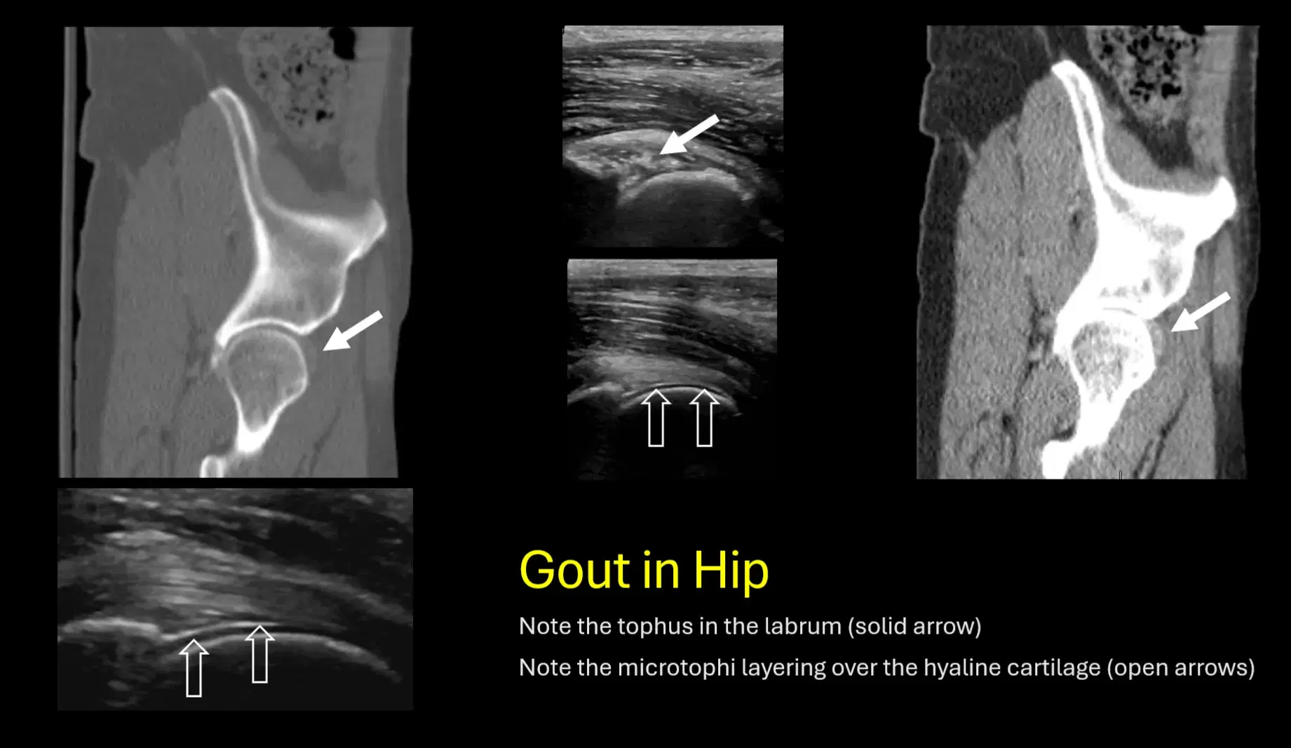 The anterior HIP CAPSULE in GOUT