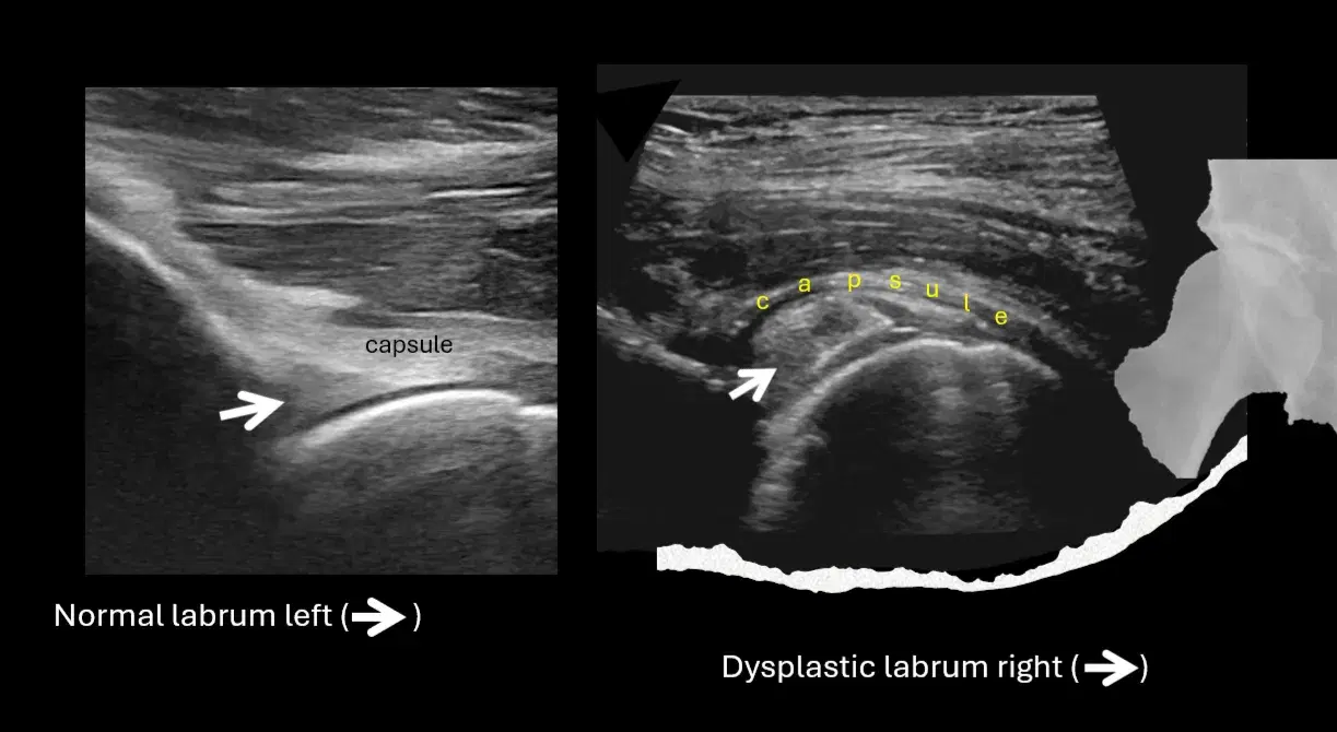 The hip capsule in dysplasia 