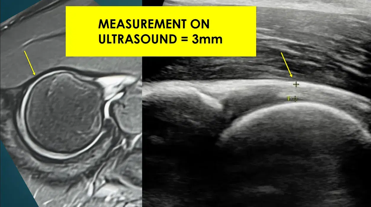 Capsule thickness - thin capsule