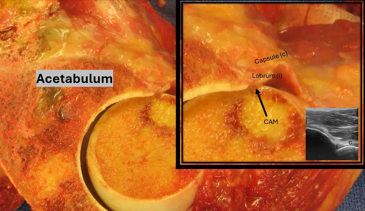 CAM effect on capsule and labrum in 60 degrees of flexion in a cadaver hip