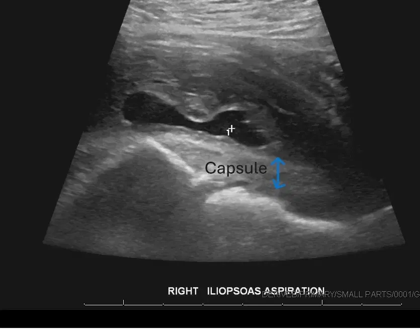 Capsule as a barrier
