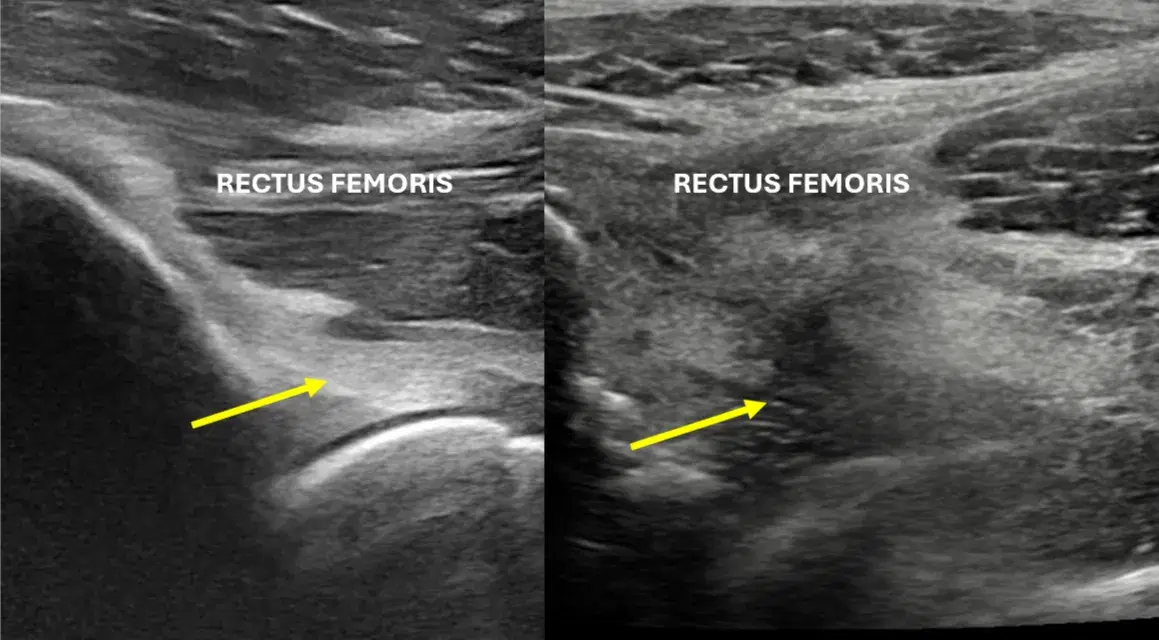 Tear of hip capsule after arthroscopy 